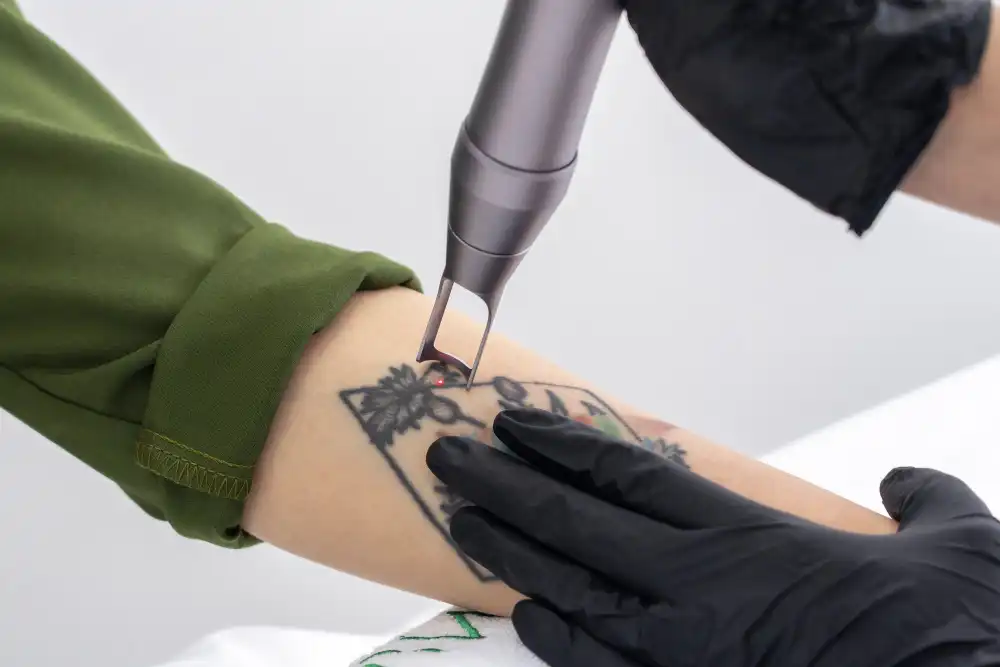 tatoo-removal